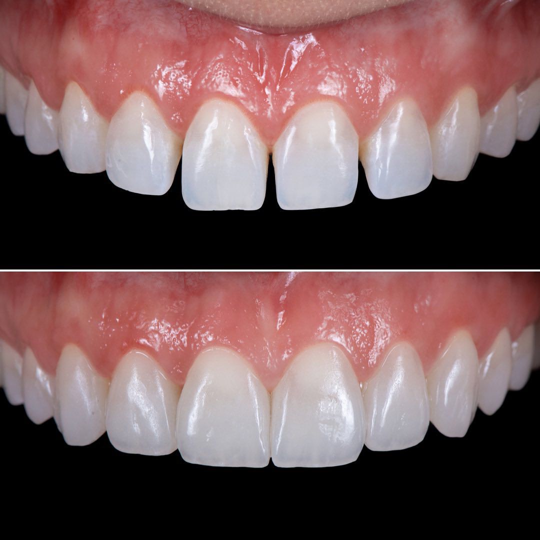 Patient D gap closure results